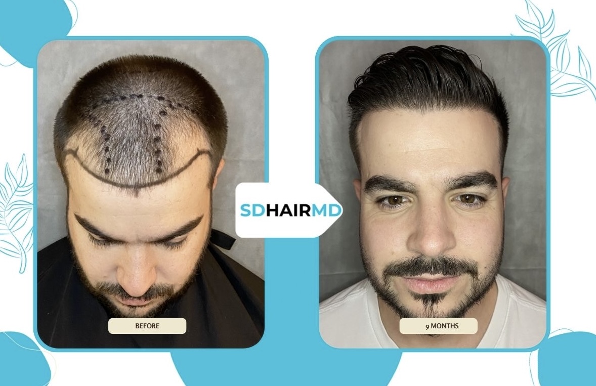 Side-by-side comparison of a man's hair before and after hair restoration, showing significant improvement in hair density.