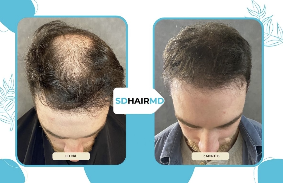 Comparison of a person's scalp showing hair loss before and after six months of treatment, with visible hair growth.