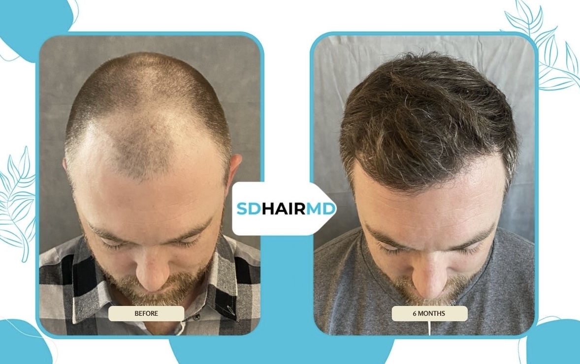 Comparison of a man's hair before and after treatment, showing increased hair density and coverage.