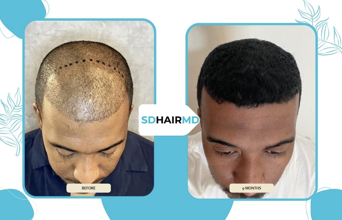 Comparison of a man's scalp before and after hair restoration, showing increased hair density after nine months.